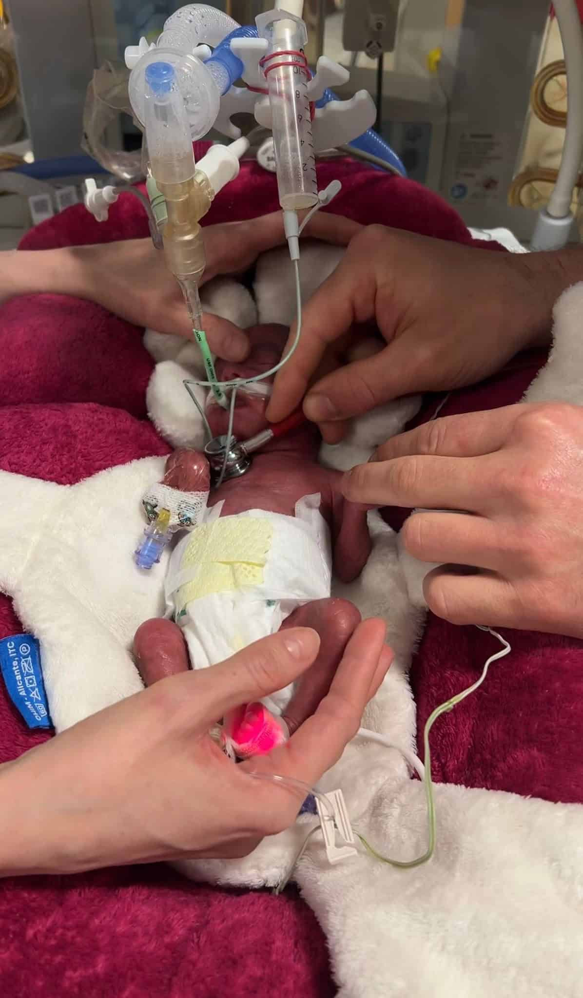 NF_NICU_Prematurita